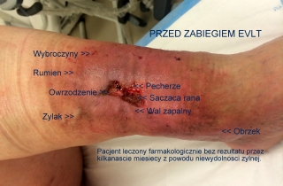 Przed EVLT. Po kilkunastu miesiącach leczenia owrzodzenia podudzia lekami doustnymi i miejscowymi, niezadowolony z leczenia Pacjent trafił do CM Golden Care, gdzie zakwalifikowano go do zabiegu EVLT.