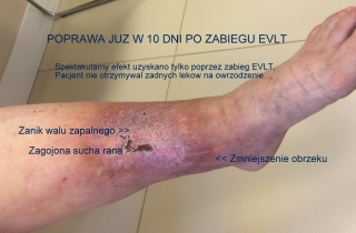 Po EVLT. Już w 10 dni od zabiegu EVLT uzyskano spektakularny efekt. Poprawa nastąpiła bez stosowania żadnych leków !