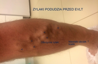 Duże żylaki podudzia przed zabiegiem EVLT