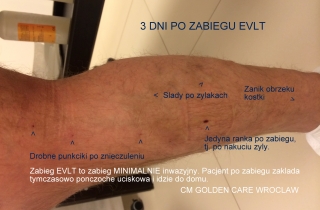 3 dni po zabiegu EVLT z powodu żylaków. Widoczne minimalne ślady po nakłuciu żyły i po znieczuleniu. Żylak zaniknął prawie całkowicie.