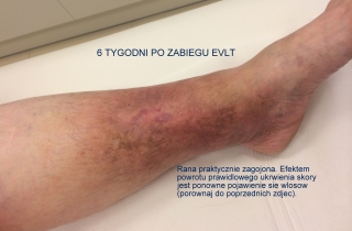 6 tygodni po leczeniu owrzodzenia podudzia w przebiegu niewydolności żylnej za pomocą zabiegu EVLT. Praktycznie zagojona rana.