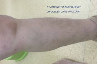 Dwa tygodnie po leczeniu rozległego żylaka podudzia przy pomocy EVLT.