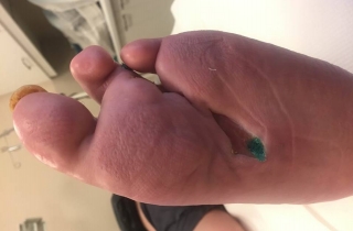 Owrzodzenie stopy pochodzenia tętniczego po kilku tygodniach leczenia.