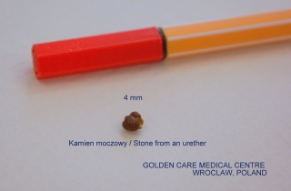 Kamień moczowy.