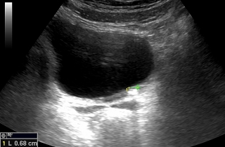 Kamień w moczowodzie przy pęcherzu moczowym.