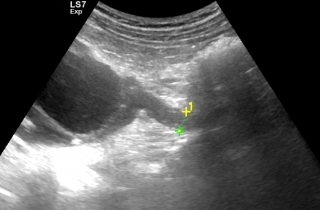 Poszerzony moczowód wywołany zablokowaniem odpływu moczu przez kamień.