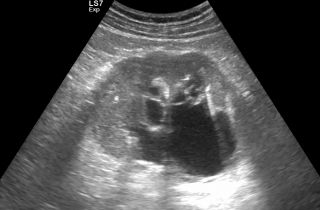 Wodonercze wywołane zablokowaniem odpływu moczu.