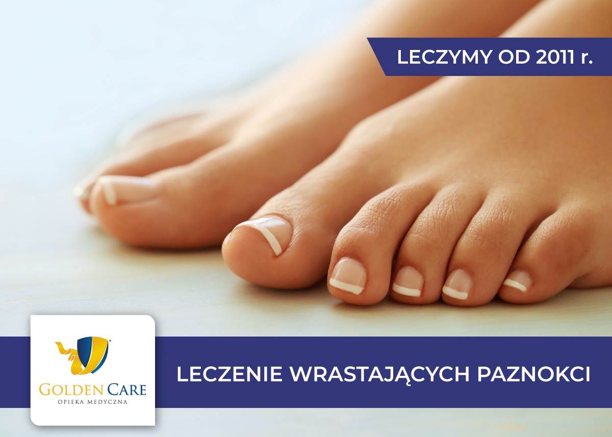 Leczenie wrastających paznokci