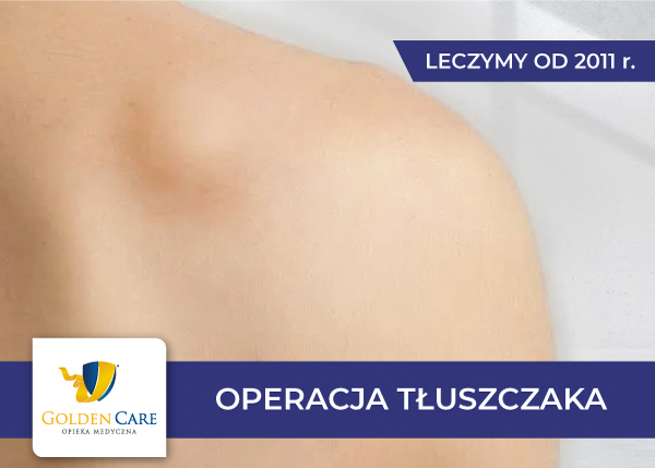 Usuwanie tłuszczaków