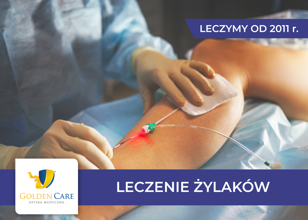 Leczenie żylaków